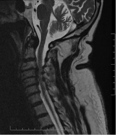 https://myelopathy.org/wp-content/uploads/Sagittal-T2-weighted-MRI-of-the-Cervical-Spine.png