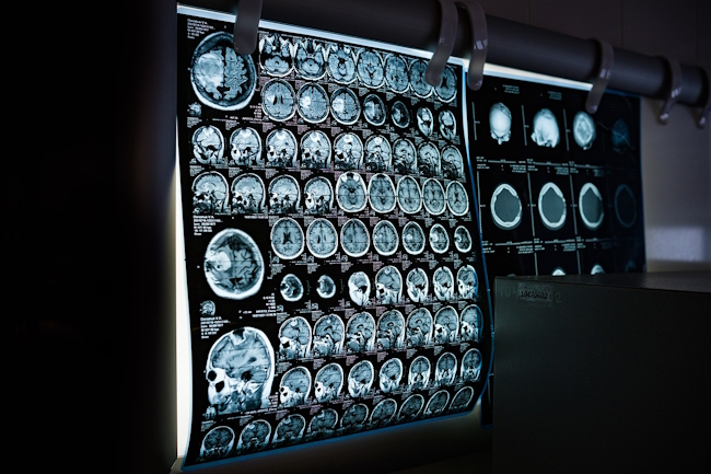 mri brain images