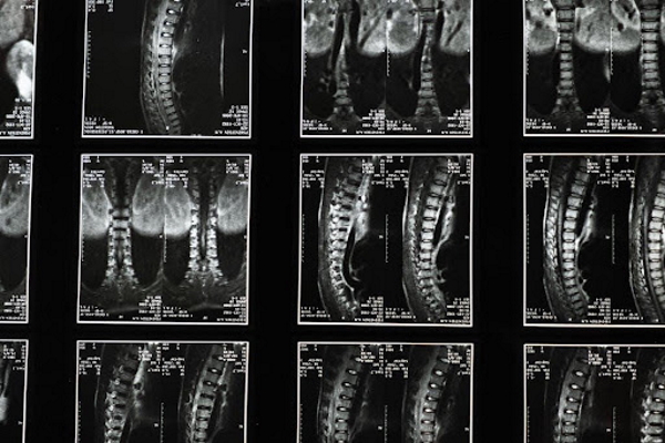 spinal cord xray images
