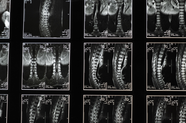 x-rays of spine
